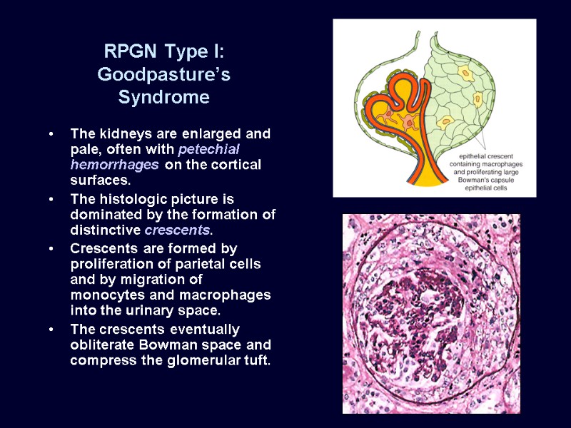 RPGN Type I: Goodpasture’s Syndrome The kidneys are enlarged and pale, often with petechial